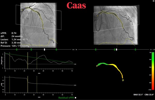 CAAS vFFR for real-time in cathlab non-invasive calculation of lesion significance CAAS vFFR for real-time in cathlab non-invasive calculation of lesion significance