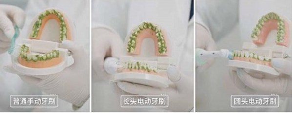清潔力對比：普通手動牙刷、長頭電動牙刷及圓頭電動牙刷
