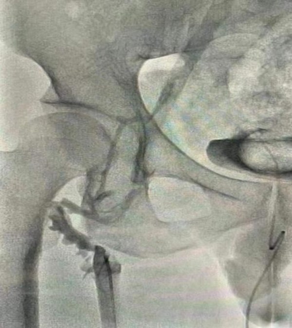 吸栓前造影顯示血栓栓塞 吸栓前造影顯示血栓栓塞