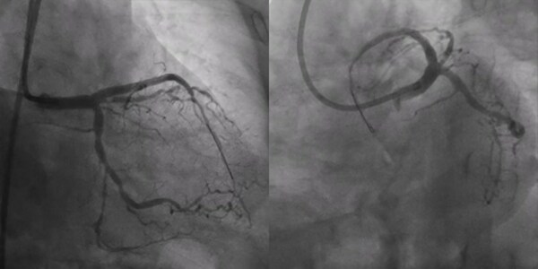 上海德達醫(yī)院心內(nèi)科成功應(yīng)用北芯國產(chǎn)單雙腔微導(dǎo)管完成CTO手術(shù)
