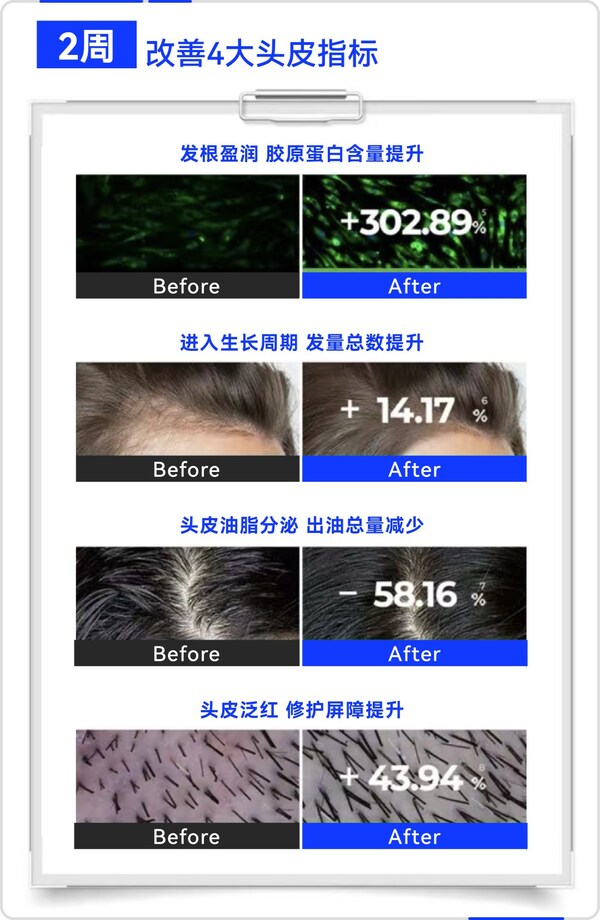 晶泰科技AI 研發(fā)平臺開發(fā)的小分子Remeanagen? 和多肽 AquaKine?聯(lián)用配方改善頭皮四大指標(biāo)，有效固發(fā)防掉發(fā)